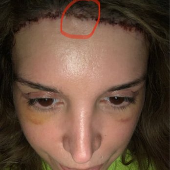 Athré Facial Plastics - A closer look at the bubble. - Cosmetic Surgeons Near Me - Houston, Texas Athré Facial Plastics - A closer look at the bubble. - Cosmetic Surgeons Near Me - Houston, Texas