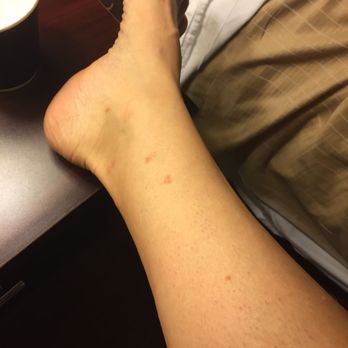 St Charles Hotel - bug bites and cigarette smoke with no solutions - Hotels Near Me - Hudson, New York St Charles Hotel - bug bites and cigarette smoke with no solutions - Hotels Near Me - Hudson, New York