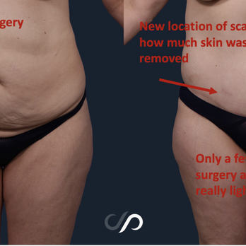 Stoker Plastic Surgery - See how much skin was removed. Only a few weeks post surgery and scars already looking good. - Cosmetic Surgeons Near Me - Marina Del Rey, California Stoker Plastic Surgery - See how much skin was removed. Only a few weeks post surgery and scars already looking good. - Cosmetic Surgeons Near Me - Marina Del Rey, California