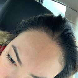 Mollura Medical Hair Restoration - My hairline is back.