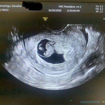 HRC Fertility - Pasadena - Healthy surro baby at 8 week heartbeat confirmation appointment. - Fertility Near Me - Pasadena, California HRC Fertility - Pasadena - Healthy surro baby at 8 week heartbeat confirmation appointment. - Fertility Near Me - Pasadena, California