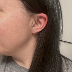 MidAmerica Plastic Surgery - About 1 month after procedure