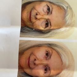 M. Polly McKinstry, M.D. - Before and After the surgery by Dr. McKinstry. No makeup. PS My dermatologist was very impressed with what she was able to do.