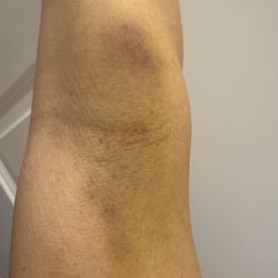 Quest Diagnostics - Large bruise on my arm 1wk post blood draw