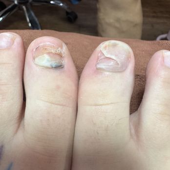 Organic Nails Studio - My toe nails before from soccer impact trauma. Both nails fell off from getting stepped on with cleats. - Nail Salons Near Me - Kirklin, Indiana