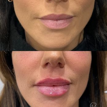 Maven Medi Spa - Lip Filler - Medical Spas Near Me - Beverly Hills, California Maven Medi Spa - Lip Filler - Medical Spas Near Me - Beverly Hills, California