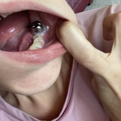 Comfort Dental - Infection and abscess that was ignored.