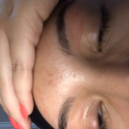 As u can see the burns from the woman waxing my brows As u can see the burns from the woman waxing my brows