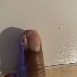 My finger after two weeks of pain and swelling My finger after two weeks of pain and swelling