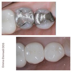 Emma Etemadi, DDS - Restoring old restorations and broken teeth with beautiful new crowns