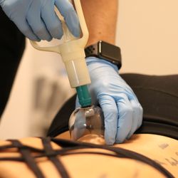 Renew Wellness - Cupping Therapy