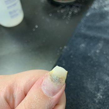 Nirvana Beauty Lounge - thumb nail with fungus growing - Nail Salons Near Me - Reno, Nevada Nirvana Beauty Lounge - thumb nail with fungus growing - Nail Salons Near Me - Reno, Nevada