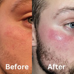 Stephen Weber, MD - Weber Plastic Surgery - Before laser surgery and after laser surgery. I have developed permanent redness, and my treated skin is over 100 degrees at all times.