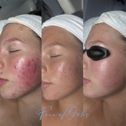 Face of Jules - CLEAR she goes. 3 treatments later.