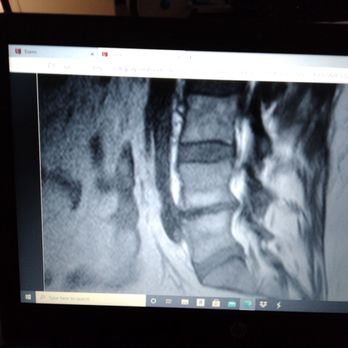 Arizona Pain and Spine - It's almost bone on bone - Pain Management Near Me - Mesa, Arizona Arizona Pain and Spine - It's almost bone on bone - Pain Management Near Me - Mesa, Arizona