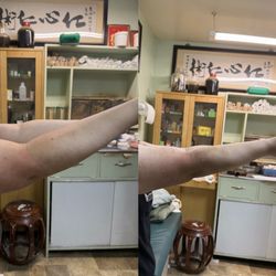 Wai Kuen Wong Herbalist Consulting Center - After about 1.5 months of treatment, I saw clear improvement--my elbow angle gradually became straighter. Dr. Wong is amazing.