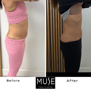 Muse Body Sculpting - Amazing before and after! - Body Contouring Near Me - Signal Hill, California Muse Body Sculpting - Amazing before and after! - Body Contouring Near Me - Signal Hill, California