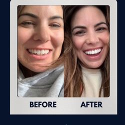 Smile the Spa - Before and after Veneers at Smile The Spa