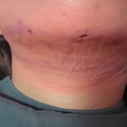 Bellisima Hair & Skin Salon - Before lymphatic massage