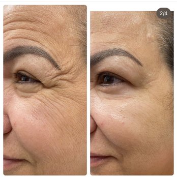 Dee's Laser & Medspa - Crow's feet tx with Botox - Medical Spas Near Me - Cape Coral, Florida Dee's Laser & Medspa - Crow's feet tx with Botox - Medical Spas Near Me - Cape Coral, Florida