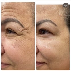 Dee's Laser & Medspa - Crow's feet tx with Botox