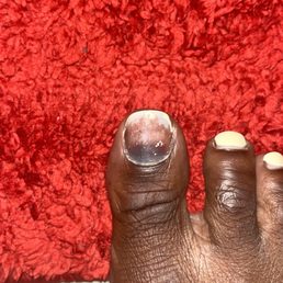 Hematoma Hematoma