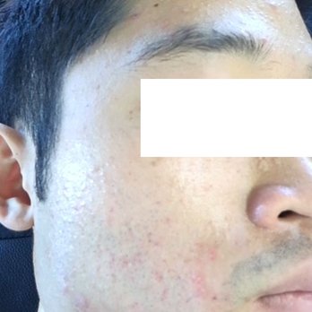 Agnes Skin Care - 7-31-2017: Day before the facial - Skin Care Near Me - Diamond Bar, California