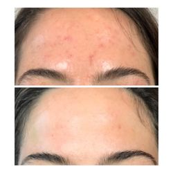 Victoria Kartseva - Ritual - Acne Treatments