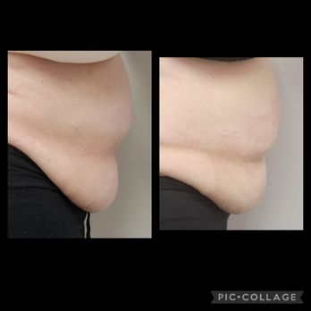 Body Secrets - Lifting that lower abdomen - Body Contouring Near Me - Lockport, New York