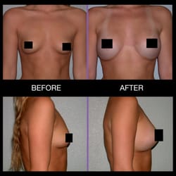 Howard Gross, MD - Mentor Smooth Round Moderate Classic profile: 360cc
