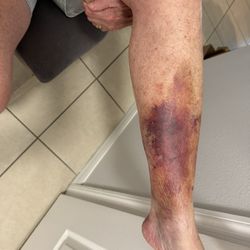 Ezell Askew, MD - Lower left leg with vien blockage