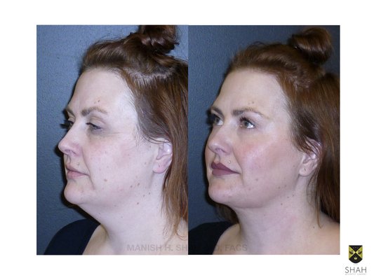 Shah Aesthetic Surgery - Rhinoplasty and Facelift Specialist by null