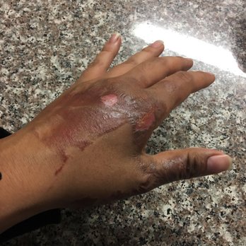 Pho 602 Vietnamese Restaurant - Third and second degree burn because they didnt close the soup correctly ! - Vietnamese Near Me - Phoenix, Arizona Pho 602 Vietnamese Restaurant - Third and second degree burn because they didnt close the soup correctly ! - Vietnamese Near Me - Phoenix, Arizona