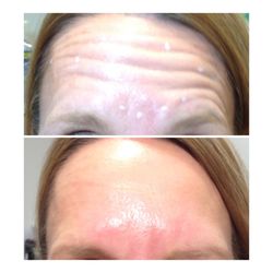 Venus Med Spa - Dysport before and after