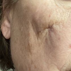 Robert B Hunsaker, DDS MD - Still experiencing tenderness and dimpling on my right cheek after a fall.