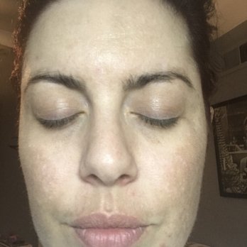 About Face by Nicky - 2weeks After peel #3 - Skin Care Near Me - Studio City, California About Face by Nicky - 2weeks After peel #3 - Skin Care Near Me - Studio City, California