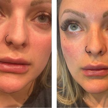 Novare Aesthetics - Touch up to lips and plasma skin treatment as well. - Aestheticians Near Me - Westminster, Colorado