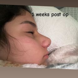 Aoc - 1 week after