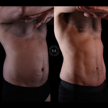 Hakimi Plastic Surgery - Lipo 360 with Renuvion Skin Tightening: liposuction of abdomen, flanks and back. - Plastic Surgeons Near Me - Beverly Hills, California Hakimi Plastic Surgery - Lipo 360 with Renuvion Skin Tightening: liposuction of abdomen, flanks and back. - Plastic Surgeons Near Me - Beverly Hills, California