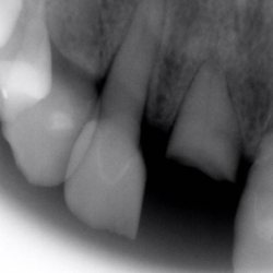 Family Dental Care - Front broken tooth replaced with implant/ abutment/ crown