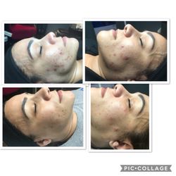 Spa Unico - TCA Chemical Peel Treatments