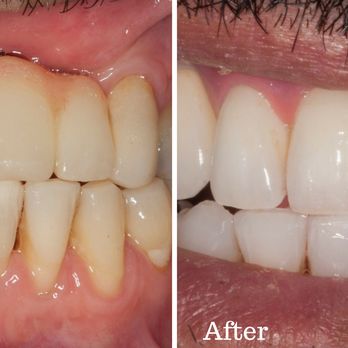 Ramin H Mahallati, DDS - Patient before and after - Cosmetic Dentists Near Me - Beverly Hills, California Ramin H Mahallati, DDS - Patient before and after - Cosmetic Dentists Near Me - Beverly Hills, California
