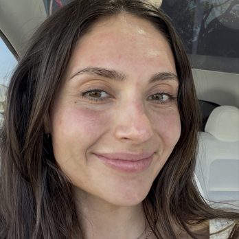 Coastal Wellness MD - 1 hour post procedure - slight redness and swelling. No discomfort! - Weight Loss Centers Near Me - Newport Beach, California