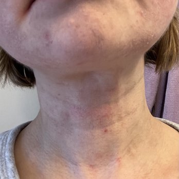 Massage Green Spa - My skin after facial. Never had that problem before in my life! Never! My skin is ruined! - Massage Therapy Near Me - Troy, Michigan