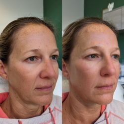 REJUV Medical - Face Rejuvenation using Dermal filler (cheeks and smile lines)