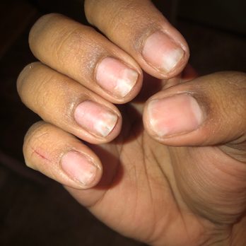 Bonita Nails & Spa - The result of my real nails after having the set taken off professionally. So damaged from Bonita. - Nail Salons Near Me - Houston, Texas