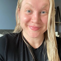 Evolve Med Spa - Montclair - After !! This is 6 days!!