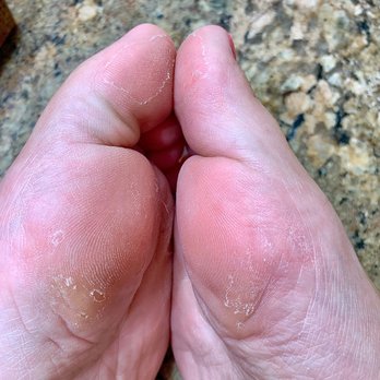 V Nail Salon - Peeling feet & toes :( - Nail Salons Near Me - Vista, California V Nail Salon - Peeling feet & toes :( - Nail Salons Near Me - Vista, California