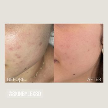 Skin By Lex - BEFORE & AFTER: acne treatments help effectively reduce acne and acne scarring, healing any blemishes on the skin. - Estheticians Near Me Skin By Lex - BEFORE & AFTER: acne treatments help effectively reduce acne and acne scarring, healing any blemishes on the skin. - Estheticians Near Me