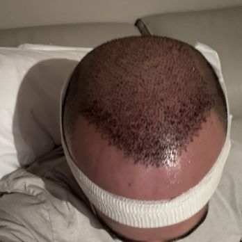 TJ Hair System - The next daub - Hair Loss Centers Near Me - Tijuana, BCN TJ Hair System - The next daub - Hair Loss Centers Near Me - Tijuana, BCN